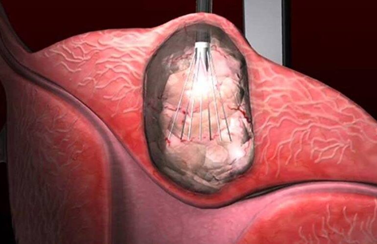 nilay-karaca-miyom-tedavisi