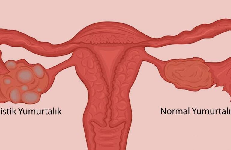 nilay-karaca-polikistik-over